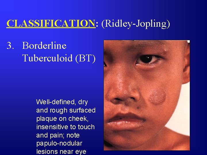 CLASSIFICATION: (Ridley-Jopling) 3. Borderline Tuberculoid (BT) Well-defined, dry and rough surfaced plaque on cheek,