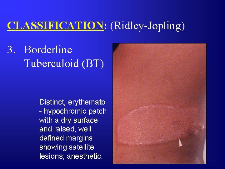 CLASSIFICATION: (Ridley-Jopling) 3. Borderline Tuberculoid (BT) Distinct, erythemato - hypochromic patch with a dry