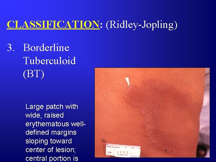 CLASSIFICATION: (Ridley-Jopling) 3. Borderline Tuberculoid (BT) Large patch with wide, raised erythematous welldefined margins