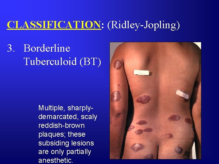 CLASSIFICATION: (Ridley-Jopling) 3. Borderline Tuberculoid (BT) Multiple, sharplydemarcated, scaly reddish-brown plaques; these subsiding lesions