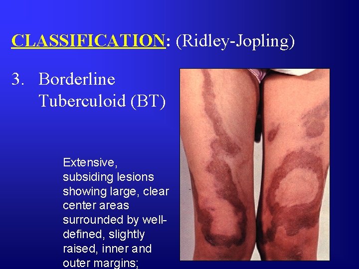 CLASSIFICATION: (Ridley-Jopling) 3. Borderline Tuberculoid (BT) Extensive, subsiding lesions showing large, clear center areas