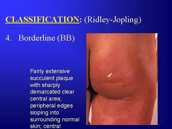 CLASSIFICATION: (Ridley-Jopling) 4. Borderline (BB) Fairly extensive succulent plaque with sharply demarcated clear central