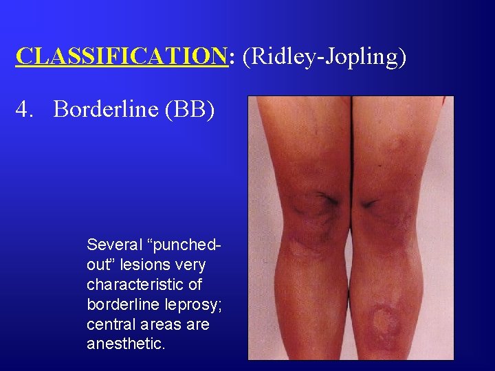 CLASSIFICATION: (Ridley-Jopling) 4. Borderline (BB) Several “punchedout” lesions very characteristic of borderline leprosy; central