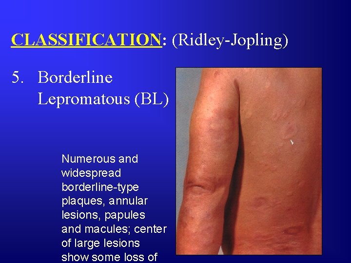 CLASSIFICATION: (Ridley-Jopling) 5. Borderline Lepromatous (BL) Numerous and widespread borderline-type plaques, annular lesions, papules