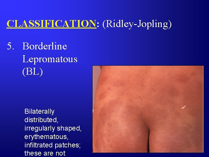 CLASSIFICATION: (Ridley-Jopling) 5. Borderline Lepromatous (BL) Bilaterally distributed, irregularly shaped, erythematous, infiltrated patches; these