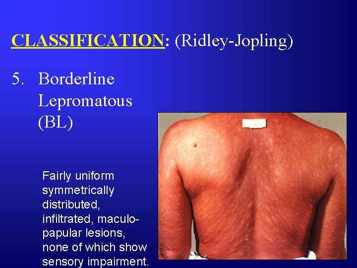 CLASSIFICATION: (Ridley-Jopling) 5. Borderline Lepromatous (BL) Fairly uniform symmetrically distributed, infiltrated, maculopapular lesions, none