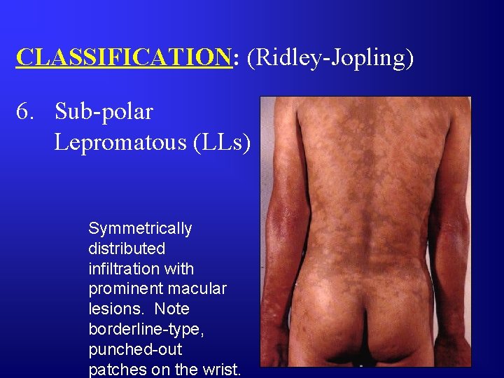 CLASSIFICATION: (Ridley-Jopling) 6. Sub-polar Lepromatous (LLs) Symmetrically distributed infiltration with prominent macular lesions. Note