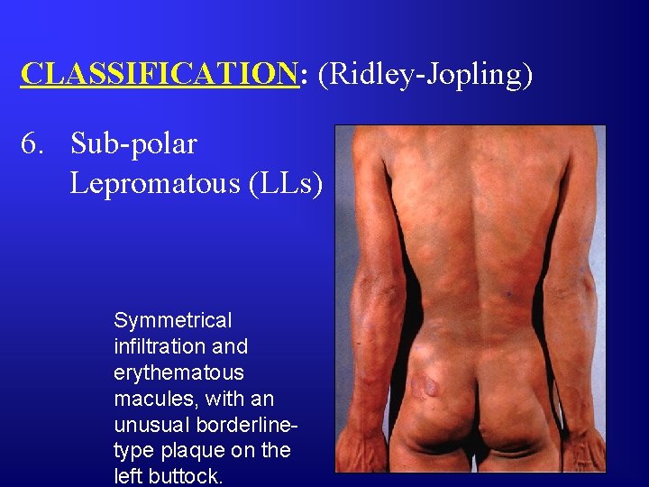 CLASSIFICATION: (Ridley-Jopling) 6. Sub-polar Lepromatous (LLs) Symmetrical infiltration and erythematous macules, with an unusual