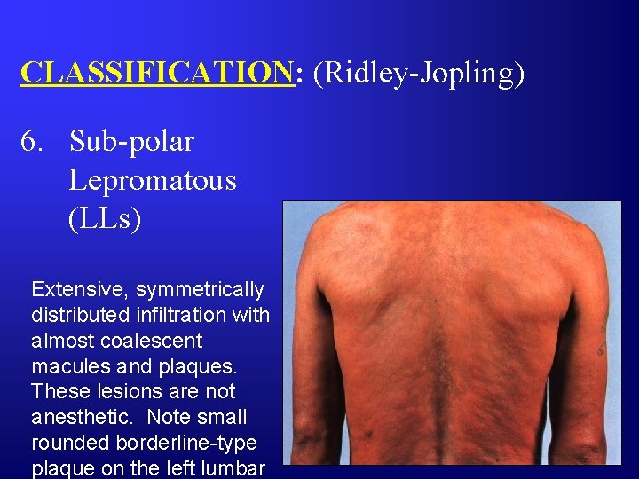 CLASSIFICATION: (Ridley-Jopling) 6. Sub-polar Lepromatous (LLs) Extensive, symmetrically distributed infiltration with almost coalescent macules