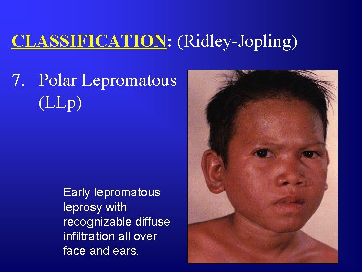CLASSIFICATION: (Ridley-Jopling) 7. Polar Lepromatous (LLp) Early lepromatous leprosy with recognizable diffuse infiltration all
