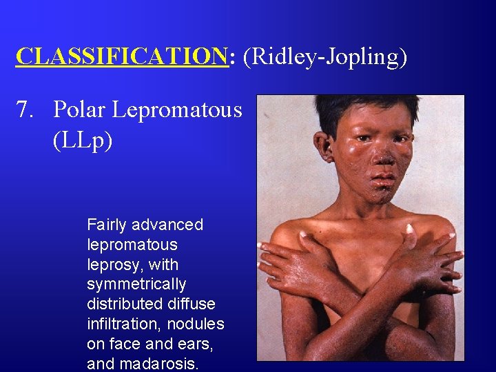 CLASSIFICATION: (Ridley-Jopling) 7. Polar Lepromatous (LLp) Fairly advanced lepromatous leprosy, with symmetrically distributed diffuse