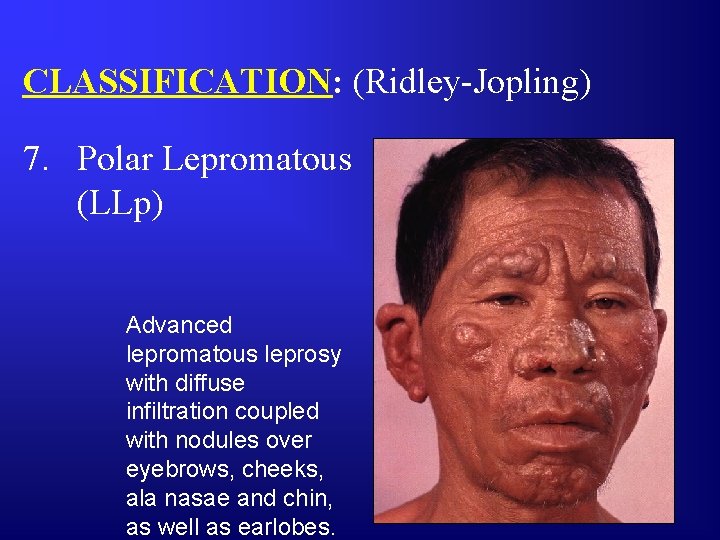 CLASSIFICATION: (Ridley-Jopling) 7. Polar Lepromatous (LLp) Advanced lepromatous leprosy with diffuse infiltration coupled with