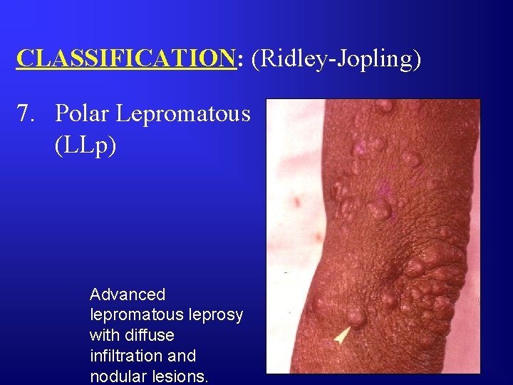 CLASSIFICATION: (Ridley-Jopling) 7. Polar Lepromatous (LLp) Advanced lepromatous leprosy with diffuse infiltration and nodular