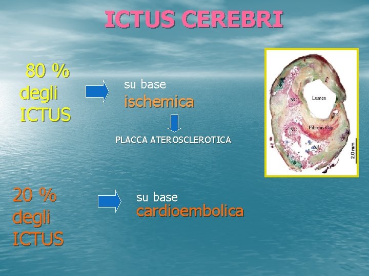 ICTUS CEREBRI 80 % degli ICTUS su base ischemica PLACCA ATEROSCLEROTICA 20 % degli