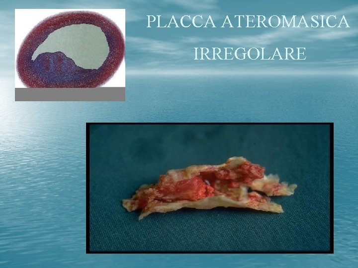 PLACCA ATEROMASICA IRREGOLARE 