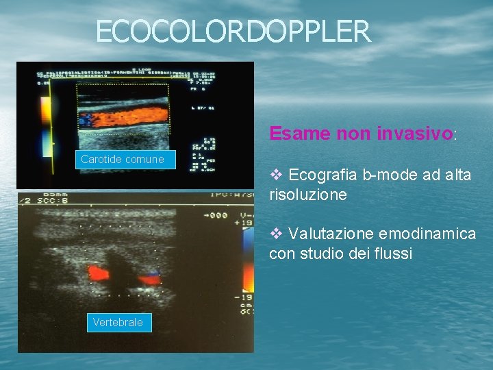 ECOCOLORDOPPLER Esame non invasivo: Carotide comune v Ecografia b-mode ad alta risoluzione v Valutazione