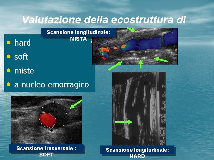 Valutazione della ecostruttura di • • hard Scansione longitudinale: MISTA placca soft miste a