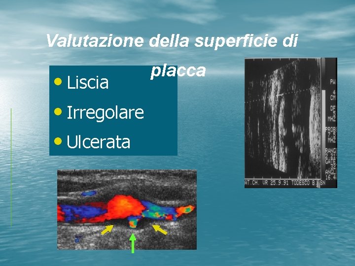 Valutazione della superficie di • Liscia • Irregolare • Ulcerata placca 