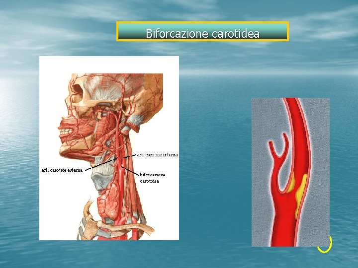 Biforcazione carotidea 