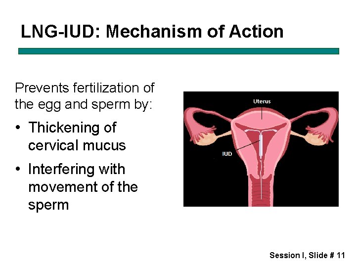 LNG-IUD: Mechanism of Action Prevents fertilization of the egg and sperm by: • Thickening