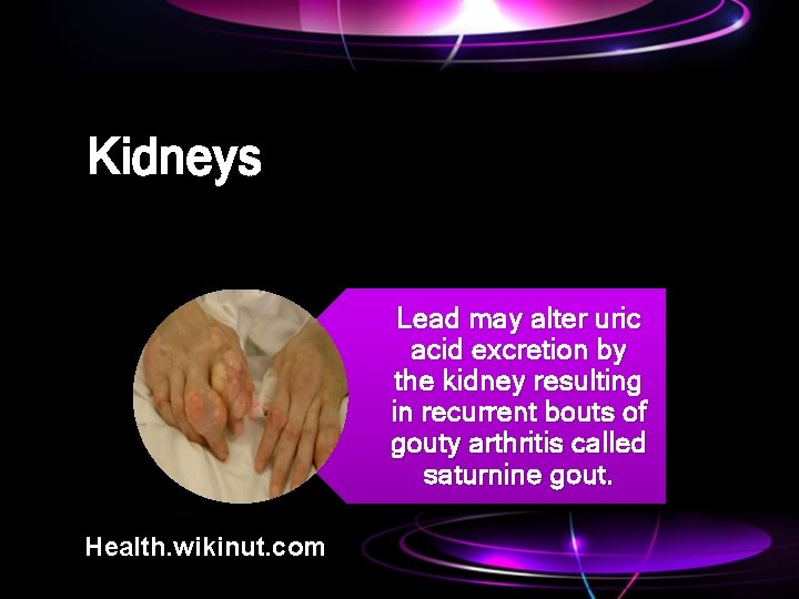 Kidneys Lead may alter uric acid excretion by the kidney resulting in recurrent bouts