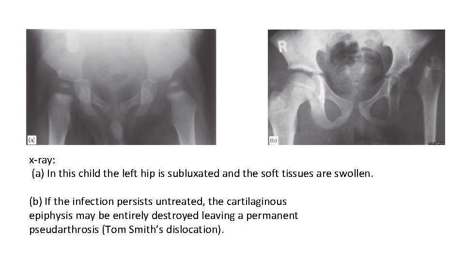x-ray: (a) In this child the left hip is subluxated and the soft tissues