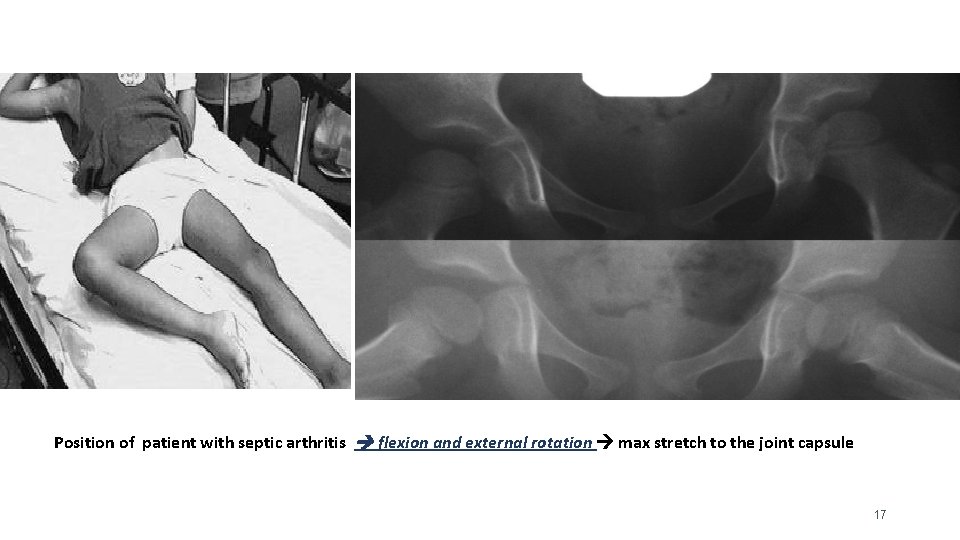 Position of patient with septic arthritis flexion and external rotation max stretch to the