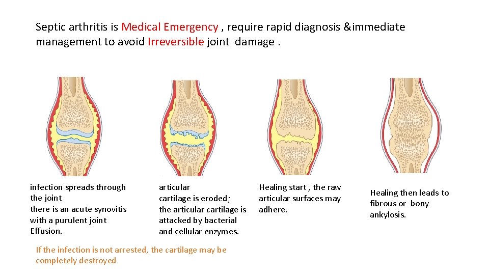 Septic arthritis is Medical Emergency , require rapid diagnosis &immediate management to avoid Irreversible