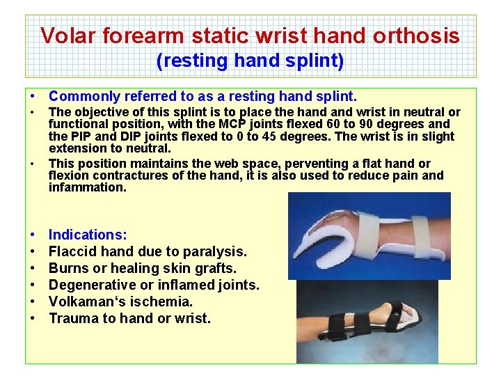 Volar forearm static wrist hand orthosis (resting hand splint) • Commonly referred to as