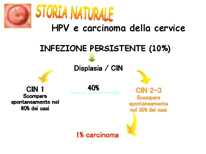 HPV e carcinoma della cervice INFEZIONE PERSISTENTE (10%) Displasia / CIN 1 40% Scompare