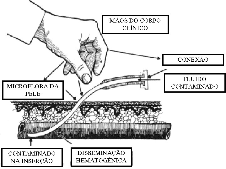 MÃOS DO CORPO CLÍNICO CONEXÃO FLUIDO CONTAMINADO MICROFLORA DA PELE CONTAMINADO NA INSERÇÃO DISSEMINAÇÃO