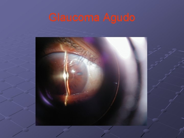 Glaucoma Agudo 