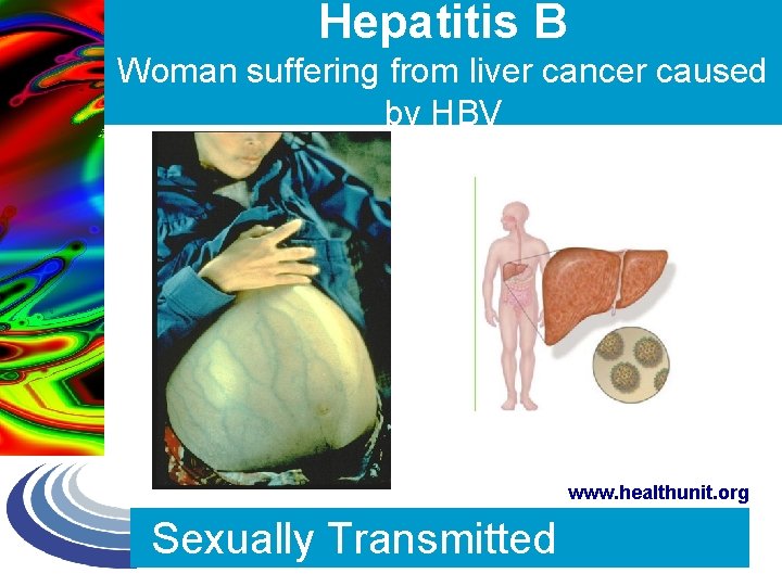Hepatitis B Woman suffering from liver cancer caused by HBV Photo courtesy of Patricia