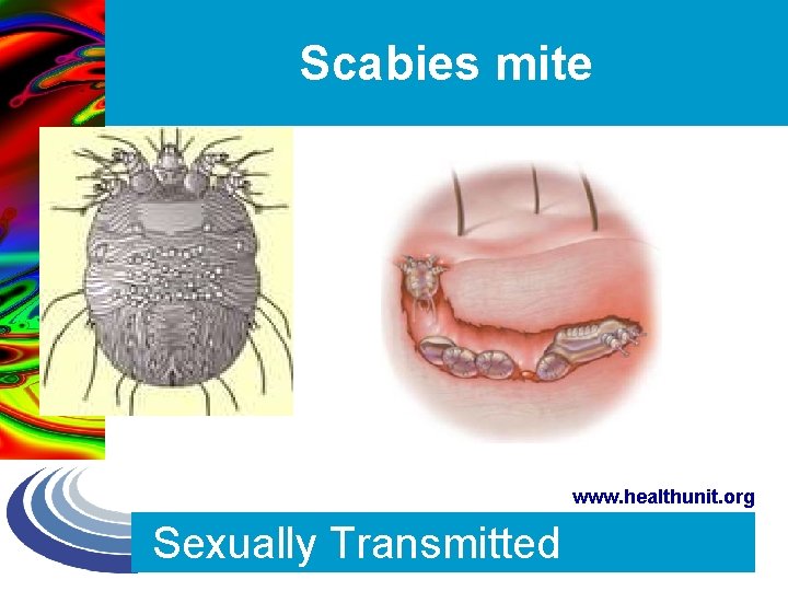 Scabies mite www. healthunit. org Sexually Transmitted 