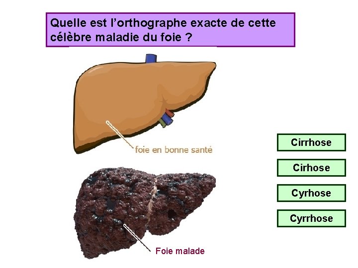 Quelle est l’orthographe exacte de cette célèbre maladie du foie ? Cirrhose Cirhose Cyrrhose