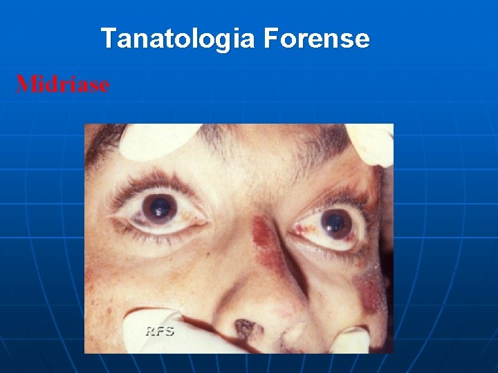 Tanatologia Forense Midríase 