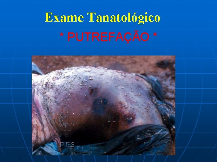 Exame Tanatológico * PUTREFAÇÃO * 