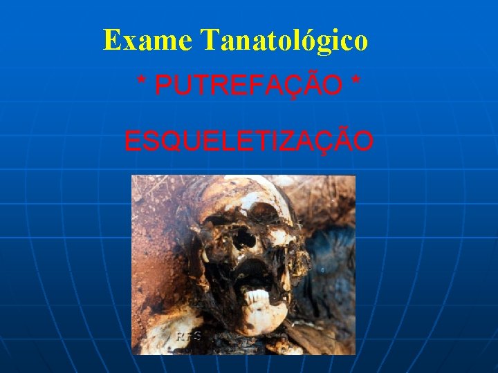 Exame Tanatológico * PUTREFAÇÃO * ESQUELETIZAÇÃO 