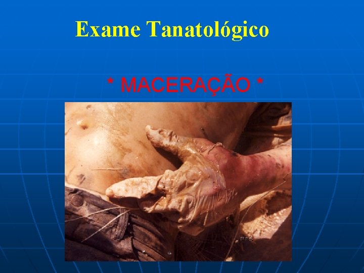 Exame Tanatológico * MACERAÇÃO * 