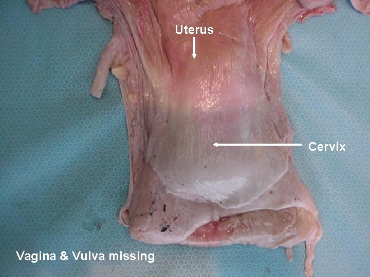 Uterus Cervix Vagina & Vulva missing 