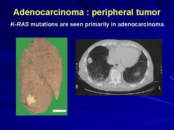 Adenocarcinoma : peripheral tumor K-RAS mutations are seen primarily in adenocarcinoma. 