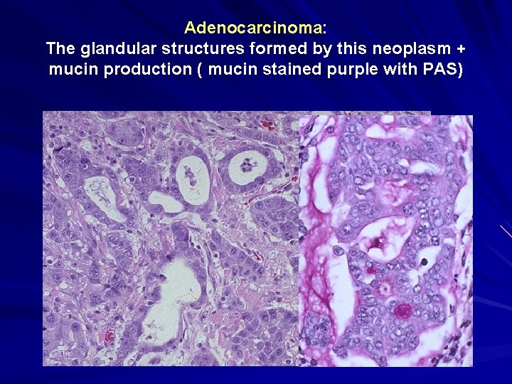 Adenocarcinoma: The glandular structures formed by this neoplasm + mucin production ( mucin stained