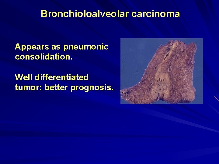 Bronchioloalveolar carcinoma Appears as pneumonic consolidation. Well differentiated tumor: better prognosis. 