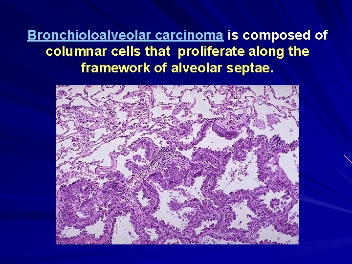 Bronchioloalveolar carcinoma is composed of columnar cells that proliferate along the framework of alveolar