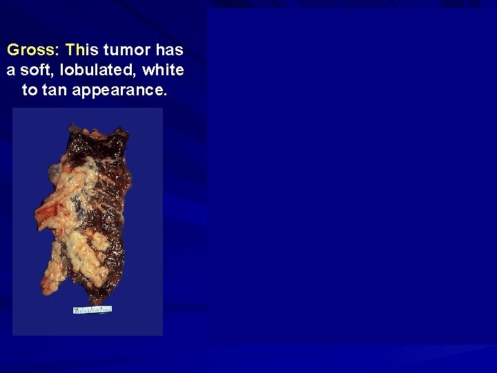 Gross: This Th tumor has a soft, lobulated, white to tan appearance. Micro: sheets