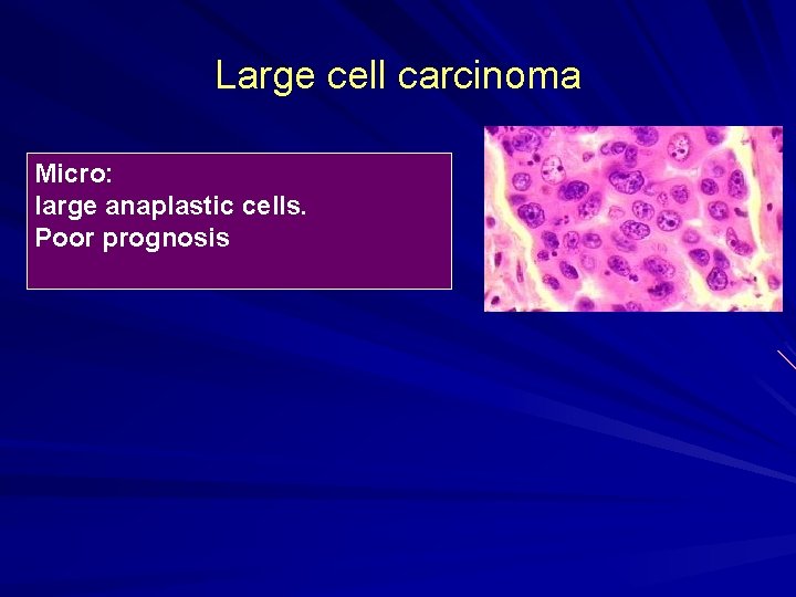 Large cell carcinoma Micro: large anaplastic cells. Poor prognosis 