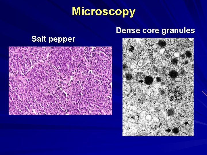 Microscopy Salt pepper Dense core granules 