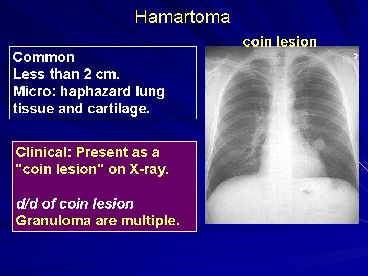 Hamartoma Common Less than 2 cm. Micro: haphazard lung tissue and cartilage. Clinical: Present