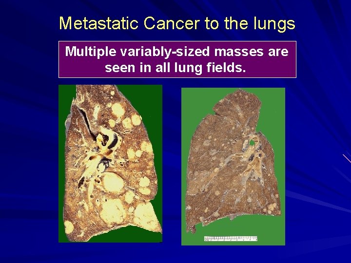 Metastatic Cancer to the lungs Multiple variably-sized masses are seen in all lung fields.