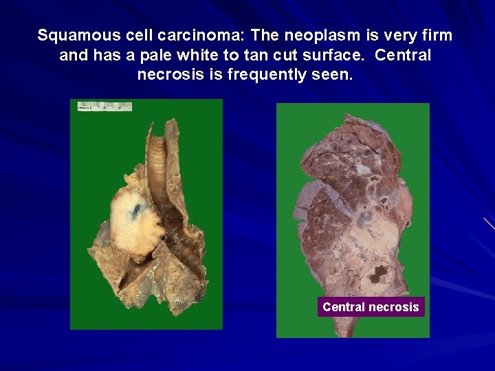 Squamous cell carcinoma: The neoplasm is very firm and has a pale white to